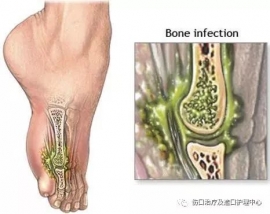 糖尿病骨髓炎外科治疗的共识