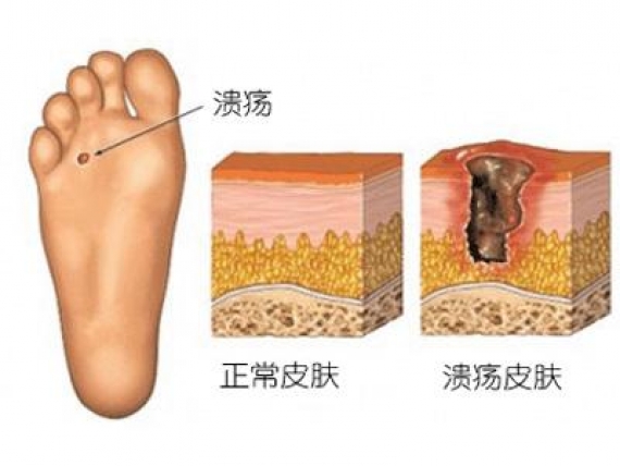 糖尿病足与糖尿病神经病变